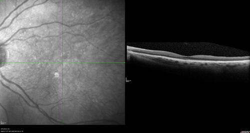 Subretinal Fluid - Inferior to the Nerve - Probable occult nerve pit
82 year old female. History of visual 