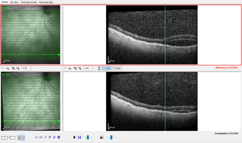 Subretinal Fluid - Inferior to the Nerve - Probable occult nerve pit
82 year old female. History of visual 