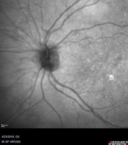 Subretinal Fluid - Inferior to the Nerve - Probable occult nerve pit
82 year old female. History of visual 