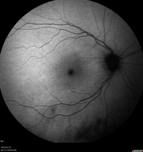 Subretinal Fluid - Inferior to the Nerve - Probable occult nerve pit
82 year old female. History of visual 