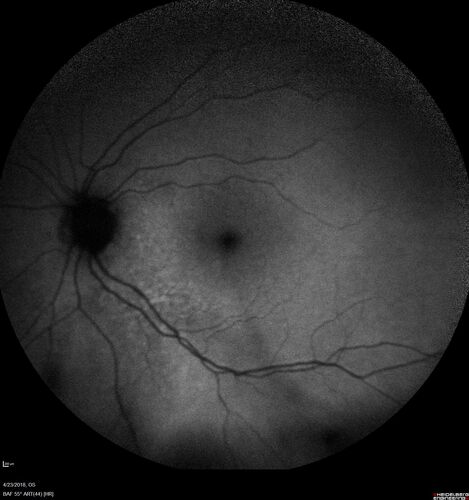 Subretinal Fluid - Inferior to the Nerve - Probable occult nerve pit
82 year old female. History of visual 