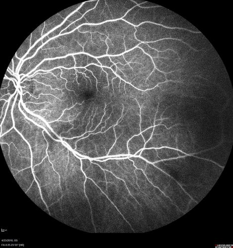 Subretinal Fluid - Inferior to the Nerve - Probable occult nerve pit
82 year old female. History of visual 