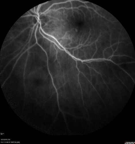 Subretinal Fluid - Inferior to the Nerve - Probable occult nerve pit
82 year old female. History of visual 