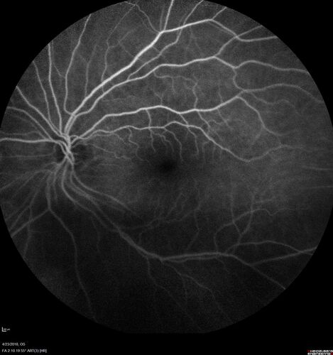 Subretinal Fluid - Inferior to the Nerve - Probable occult nerve pit
82 year old female. History of visual 