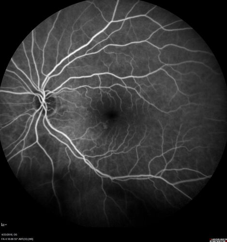 Subretinal Fluid - Inferior to the Nerve - Probable occult nerve pit
82 year old female. History of visual 