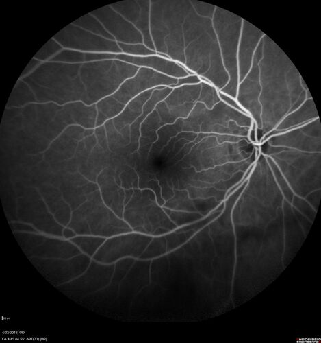 Subretinal Fluid - Inferior to the Nerve - Probable occult nerve pit
82 year old female. History of visual 