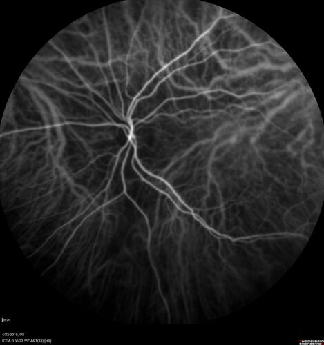 Subretinal Fluid - Inferior to the Nerve - Probable occult nerve pit
82 year old female. History of visual 