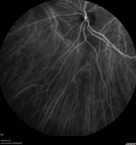Subretinal Fluid - Inferior to the Nerve - Probable occult nerve pit
82 year old female. History of visual 