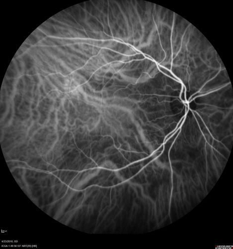 Subretinal Fluid - Inferior to the Nerve - Probable occult nerve pit
82 year old female. History of visual 